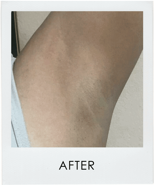 THE EASIEST FIX FOR DARK UNDERARMS