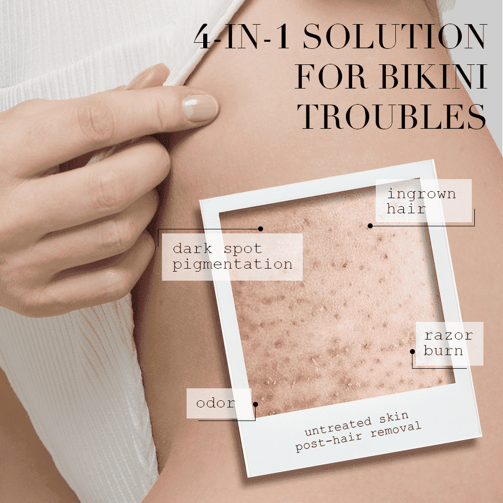 Post-hair removal skin issues (ingrown hairs, dark spots, razor burn, odor) highlighted as "bikini troubles," advertising a 4-in-1 solution.